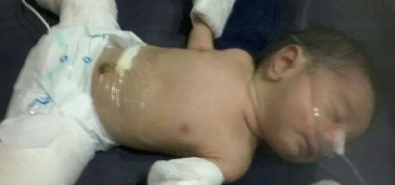 Hindistan'da bir bebek 'hamile' doğdu