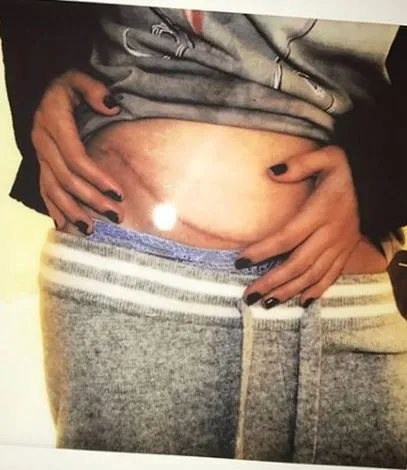 Selena Gomez böbrek nakli oldu - 1