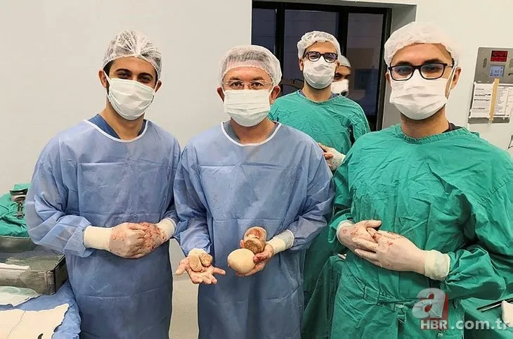 Karın bölgesinde şişlik ve halsizlik şikayetiyle doktora gitti! Karnından çıkanlar şoke etti 8