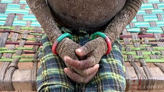 Vücudu her geçen gün taşa dönüşüyor! 1