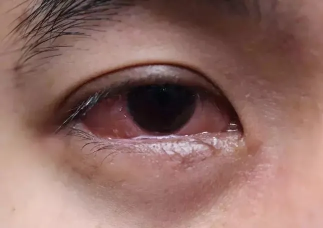 Göz alerjisi neden olur?