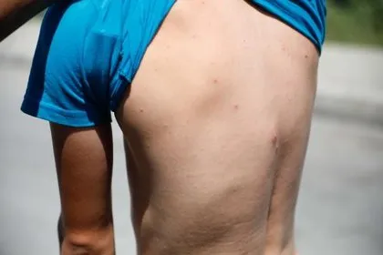 Isırdığı anda beyni küçültüyor! İstanbul’da ’Aedes’ tehlikesi