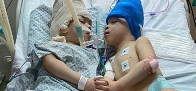 Tarihe geçen ameliyat: Yapışık ikizleri sanal gerçeklik ayırdı