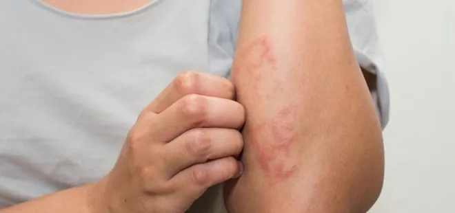 Egzama nasıl geçer? Egzama nedenleri ve belirtileri...