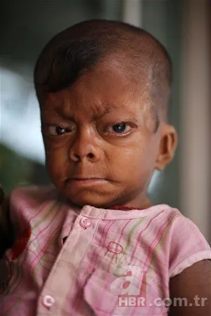 Dünyanın en tuhaf hastalıkları 9