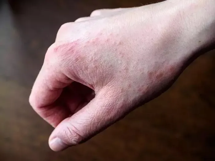 Egzamayı tetikliyor! Sakın bu hataları yapmayın...