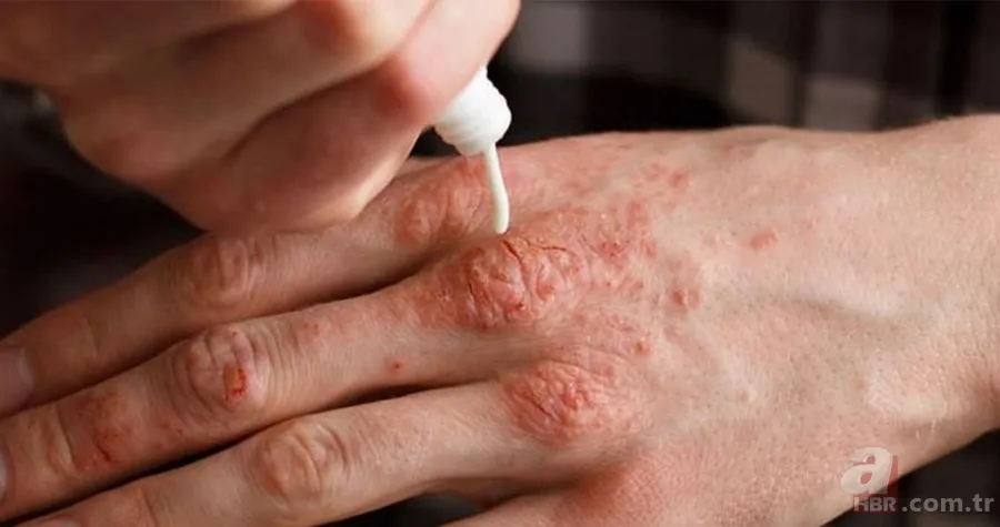 Kuruluğa, kızarıklığa ve acıya son! Eldeki kaşıntı ve egzamayı rahatlatacak yöntem! Tek damlasını sürünce... 5