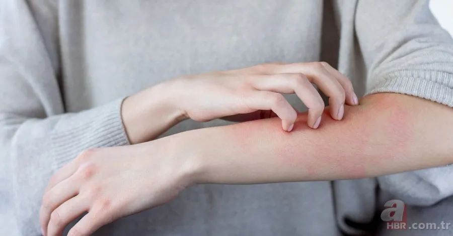 Egzamayı 24 saat içinde yok oluyor! Yarım litre suya bir tutam eklemeniz yetecek! 2