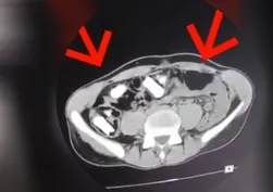 Uyuşturucu sevkiyatına darbe! Takibe alınmıştı midesinden çıkanlar şoke etti