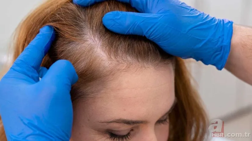 Kaşınan ve kepeklenen saçınız varsa dikkat! Bu yöntemle hem rahatlayacak hem de saçınızı uzatacaksınız 4