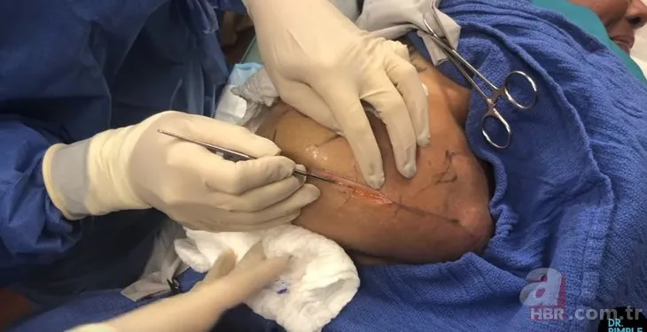 Sırtındaki dövmenin altında oluşan şişlik için doktora gitti 👩‍⚕️ Operasyonu gerçekleştiren doktor bile şaştı kaldı! Bakın sırtından ne çıktı