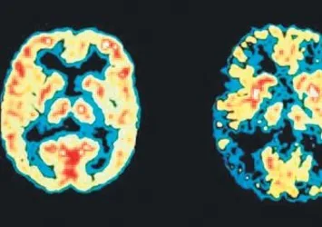 Alzheimer’a ‘genetik çözüm’ bulundu