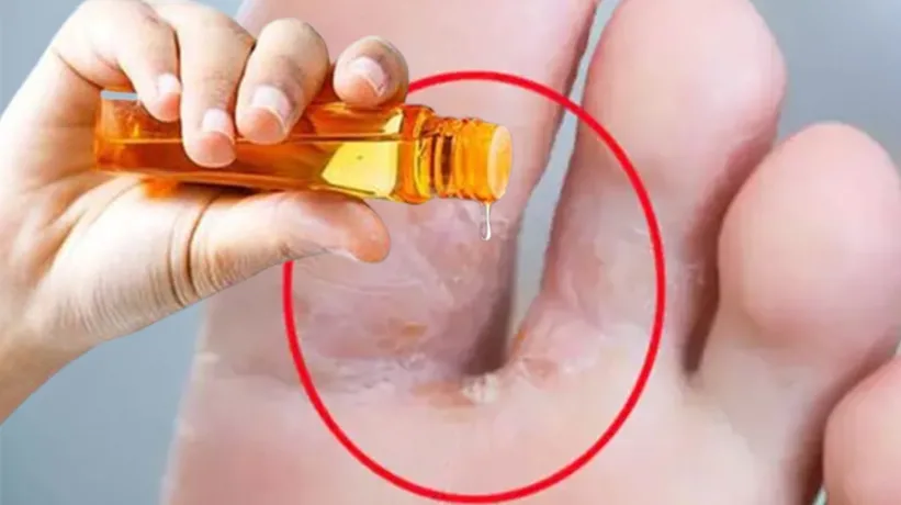Ayak mantarını söküp atan yöntem! 10 dakikada pamuk gibi yapıyor