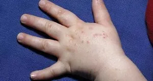 El ve ayak hastalığı havuz suyundan bulaşabilir!