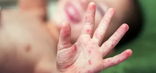 El ayak ağız hastalığında hijyen kurallarına dikkat!