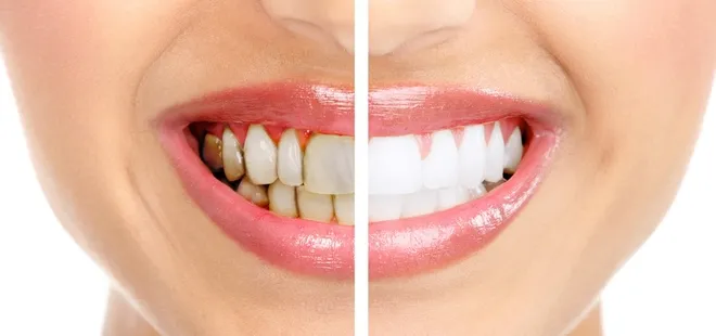 Leke çıkarıcı diş macunlarına dikkat!