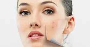 Çok antibiyotik ‘süper akne’ yaratıyor