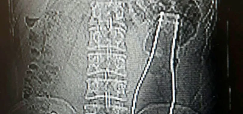 Karaman’da karın ağrısı şikayetiyle hastaneye gitti kalın bağırsağında soda şişesi çıktı