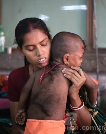 Dünyanın en tuhaf hastalıkları 10