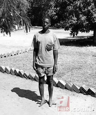 Dünyanın en tuhaf hastalıkları 20