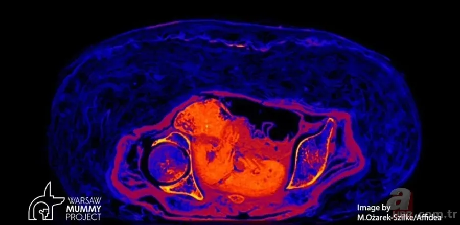 Doğmamış çocuğuyla mumyalandı: 2 bin yıl nasıl bozulmadan kaldı? "Gerçek bir insanlık trajedisi" 2