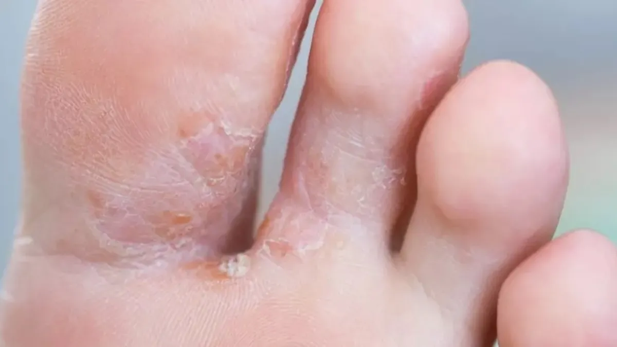 Mantar enfeksiyonuna dikkat! Uzmanından hayat kurtaran tavsiyeler