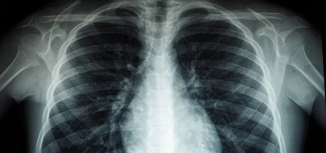 Uzmanlar uyarıyor: Akciğer hastaları yaylalardan uzak durmalı