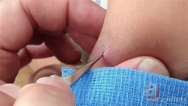 Kolundaki sivilceden böcek çıktı 👩⚕️ Doktora gidince şoke oldu | Cımbızla çektikçe içi gitti 6