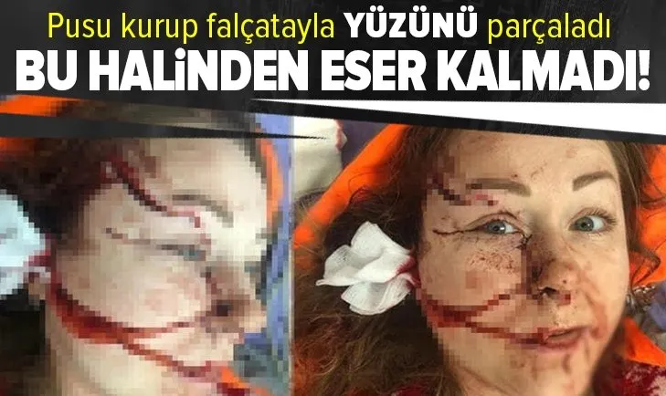 Boşanmak istediği için kocasının yüzünü falçatayla parçalandığı Ukraynalı Hanna yeni bir hayat kurdu