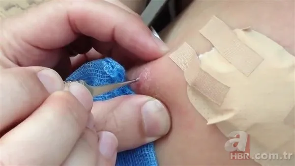 Kolundaki sivilceden böcek çıktı 👩⚕️ Doktora gidince şoke oldu | Cımbızla çektikçe içi gitti 14