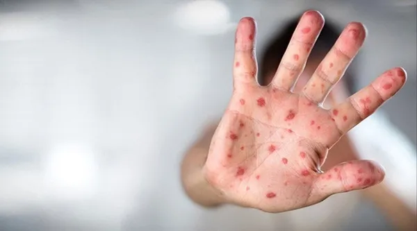Son dakika: Maymun çiçeği Türkiye'de kaç kişide var? Sağlık Bakanı Fahrettin Koca açıkladı - 3