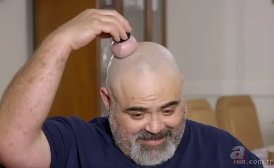 Sokağa şapka ile çıkıyordu! Başındaki şişlikten bakın ne çıktı 👩⚕️ Görenleri şaşkına çeviren olay 4