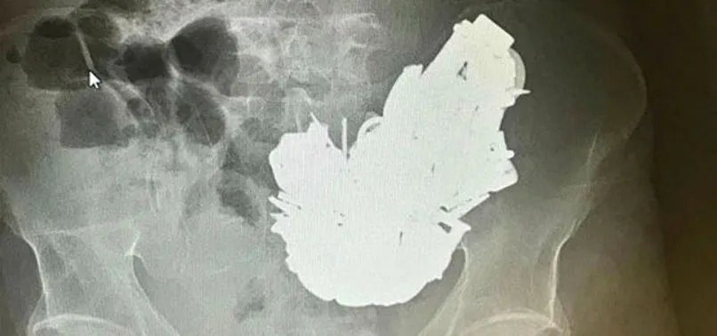 İzmir’de 680 gram metal yutan kişi hayatını kaybetti