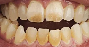 Diş nasıl beyazlatılır?