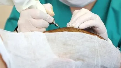 Saç ektirmek için İstanbul’a geldi başına gelmeyen kalmadı!