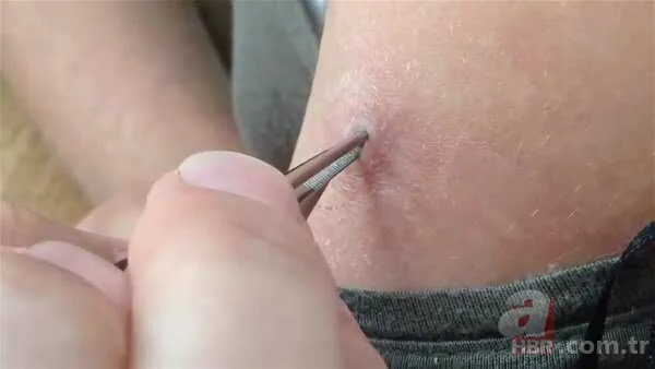 Genç kadının kolundan çıkanlar şoke etti 7