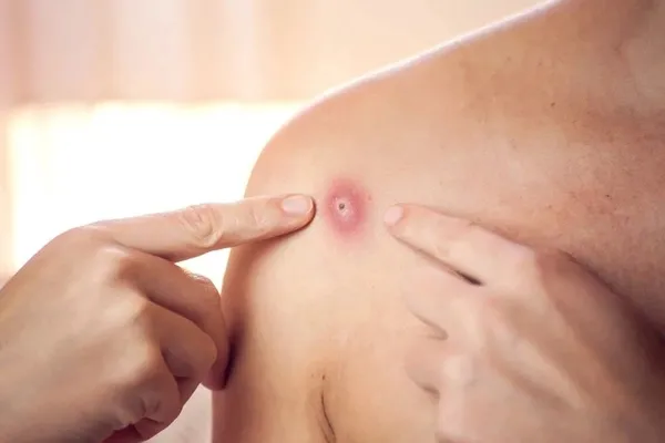 Son dakika: Maymun çiçeği hastalığı Türkiye’de! Sağlık Bakanı Fahrettin Koca duyurdu | Maymun Çiçeği hastalığı hangi ilde görüldü