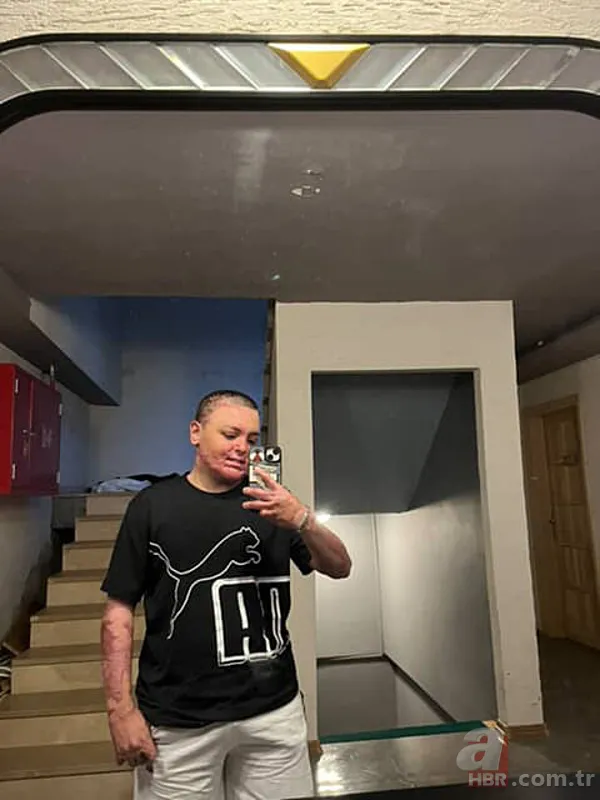 Kuaförde korkunç olay! 14 yaşındaki çocuğun tüm vücudu yandı 8