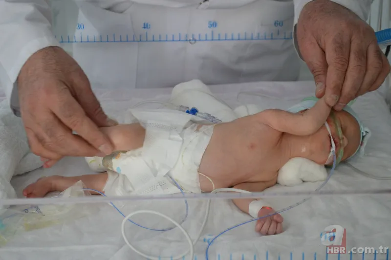 40 binde bir görülüyor! Kilosu kadar tümörle dünyaya geldi | Dünyanın en ilginç hastalıkları 1