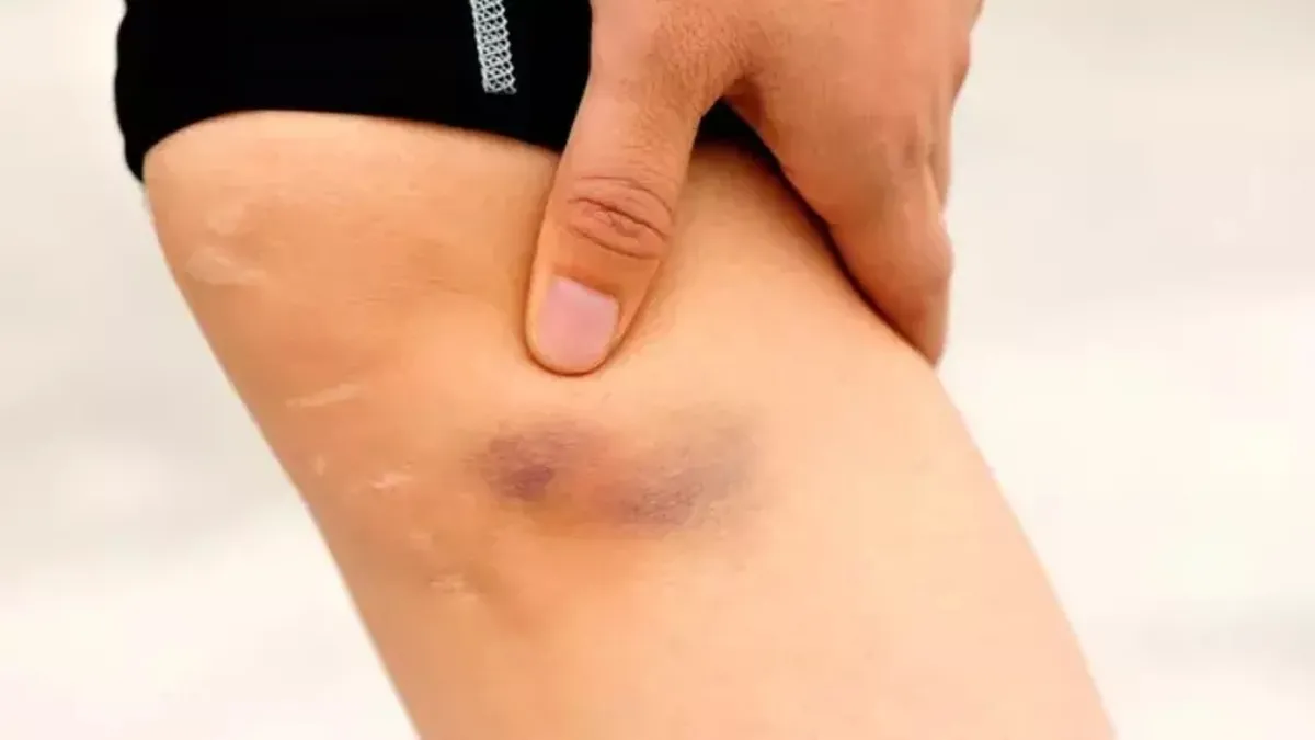 Vücudunuzun sinyallerine kulak verin: Tek taraflı şişlik pıhtı habercisi olabilir