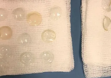 Gözünden 27 kontakt lens çıkartıldı
