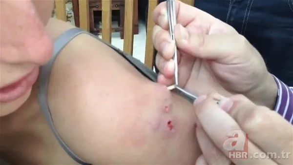Kolundaki sivilceden böcek çıktı 👩⚕️ Doktora gidince şoke oldu | Cımbızla çektikçe içi gitti 24