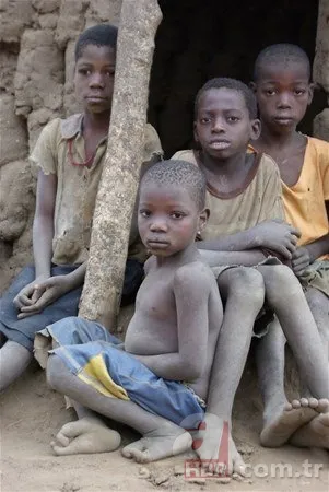 Dünyanın en tuhaf hastalıkları 17