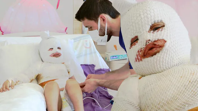 Kars’ta üstüne kaynar su dökülen 2 yaşındaki Hamit’in vücudu sargılarla kaplandı - 4