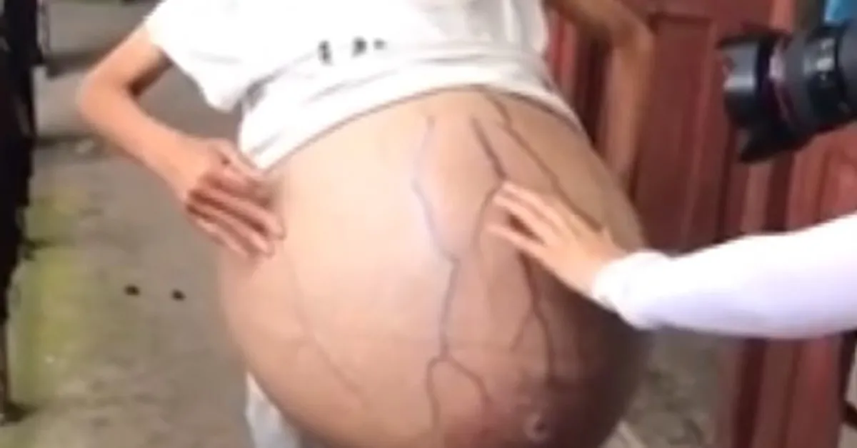 Son dakika: Tıp dünyası şokta! Aniden karnı şişti! Genç kadındaki 20 kiloluk kütlenin gizemi çözülemiyor