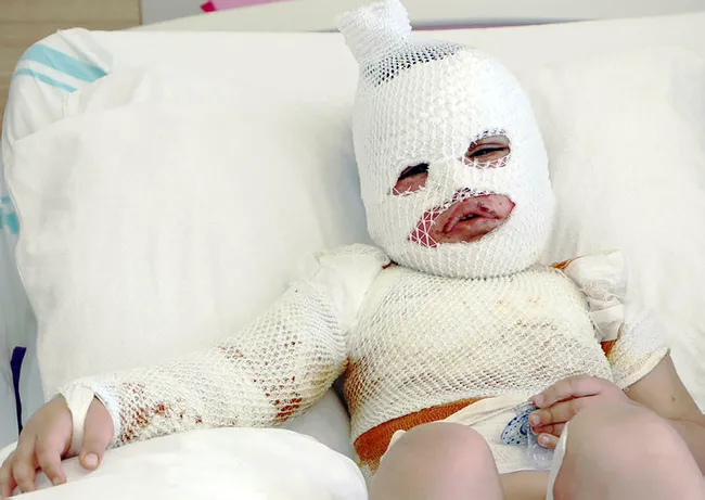 Kars’ta üstüne kaynar su dökülen 2 yaşındaki Hamit’in vücudu sargılarla kaplandı - 2