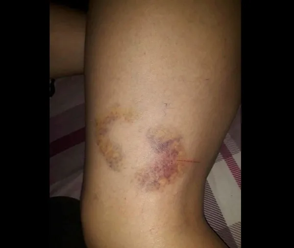 1672027870563.jpg Yeni evli kadın kabusu yaşadı! Severek evlendiği kişi kaburgasını çatlatıp vücudunda sigara söndürdü - 5