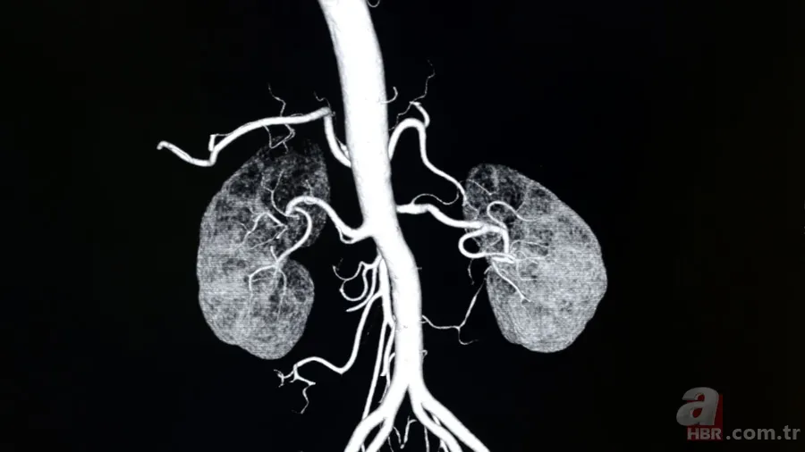 Aort damarı yırtıldığında ne olur? Aort damarı yırtılması nedir, neden olur? Belirtileri ve tedavi yöntemleri 5