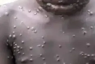 Maymun çiçeği virüsü nedir? Türkiye’de görüldü mü? Maymun çiçeği hastalığı nasıl bulaşır, belirtileri neler?