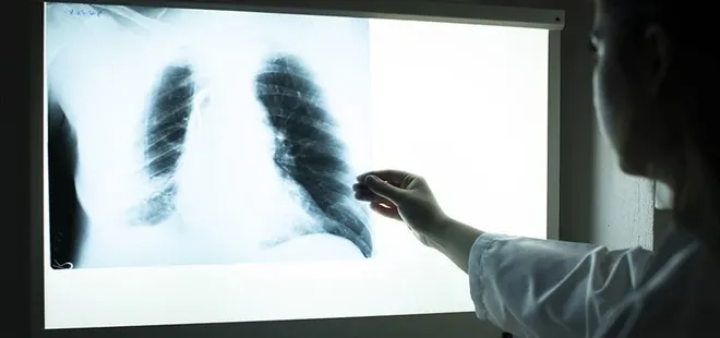 Uzmanı uyardı: KOAH’lı hastaların uzak durması gereken yiyecekler...